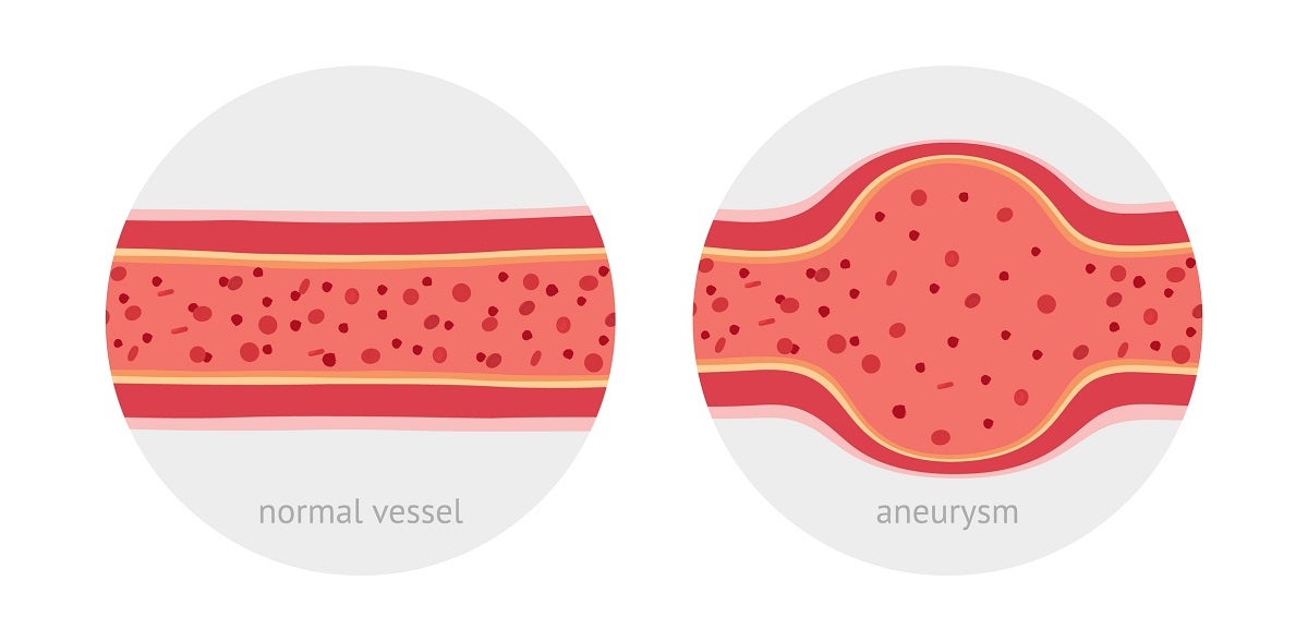 Abdominal Aortic Aneurysm