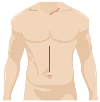 Traditional Surgery incision
