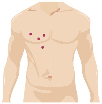 Robotic Surgery Incision