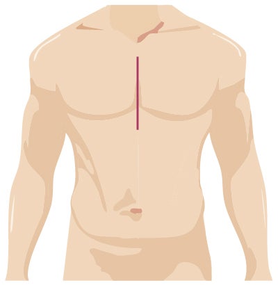 Traditional surgery incision