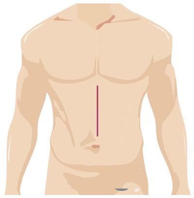 Traditional Surgery Location for colorectal surgery