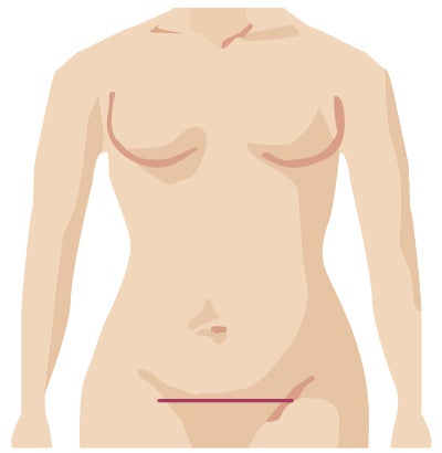 Traditional surgery incision from urogynecologic surgery