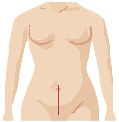 Traditional surgery incision from gyn onc surgery