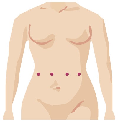 Robotic surgery incision from gynecologic surgery