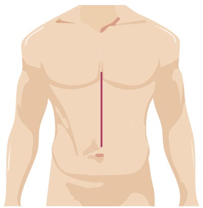 Traditional surgery incision for general robotic surgery