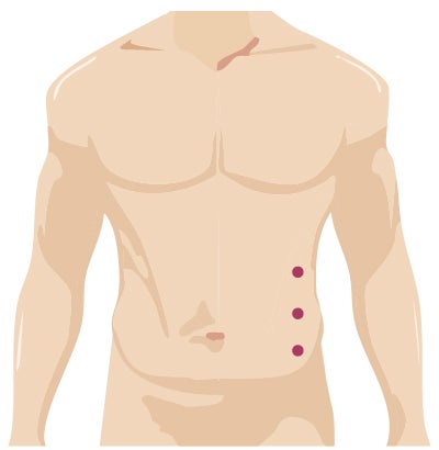 Robotic surgery incision for general surgery