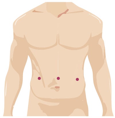 Robotic surgery incision for hernia