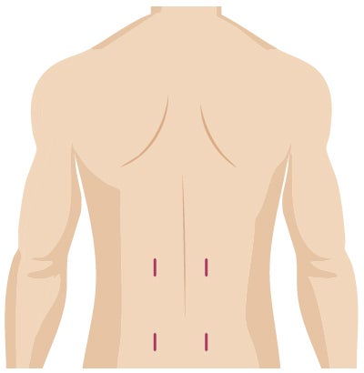 Minimal scars from robotic spine surgery