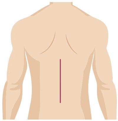 Traditional surgery incision from spine surgery