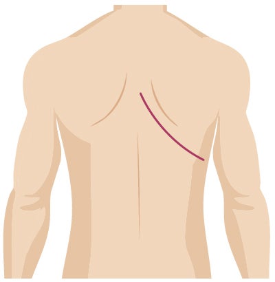 Traditional surgery incision for thoracic surgery