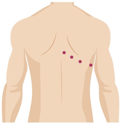 Robotic surgery incision from thoracic surgery