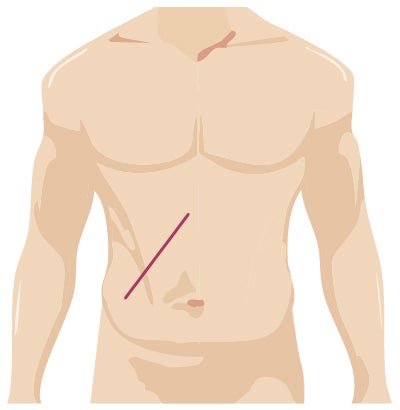 Traditional surgery incision from urology surgery