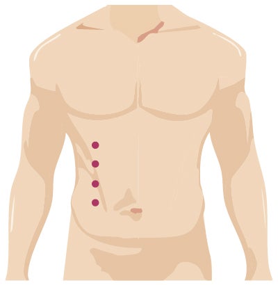 Robotic surgery incision from urology surgery